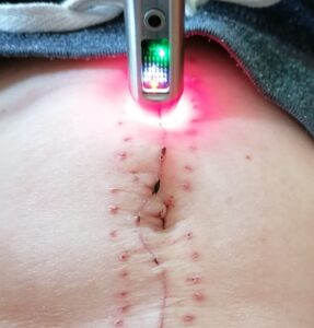 Laser-Akupunktur